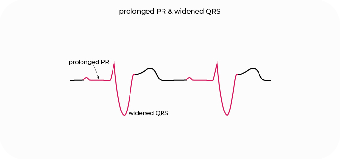prolonged pr and widened qrs
